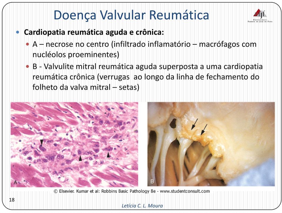 -Valvulitemitral reumática aguda superposta a uma cardiopatia reumática
