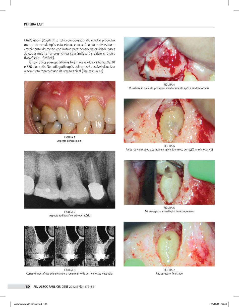 Os controles pós-operatórios foram realizados 72 horas, 32, 91 e 725 dias após. Na radiografia após dois anos é possível visualizar o completo reparo ósseo da região apical (Figuras 9 a 13).