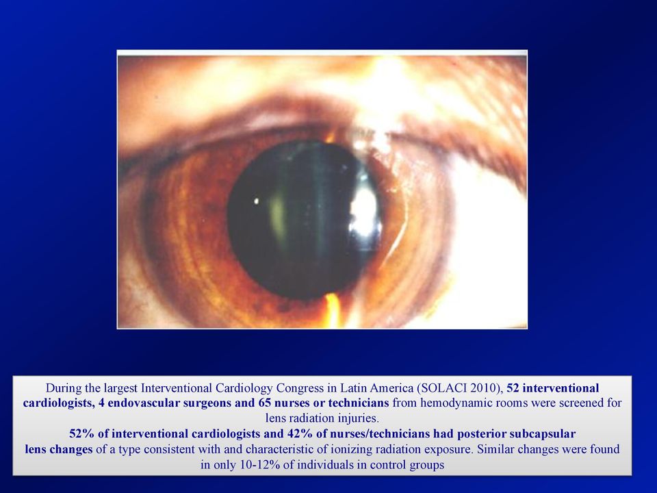 52% of interventional cardiologists and 42% of nurses/technicians had posterior subcapsular lens changes of a type