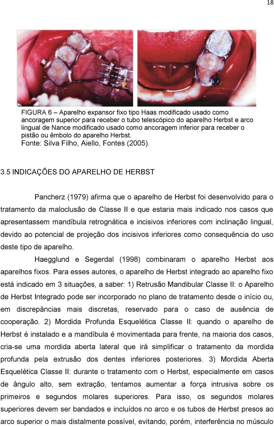 5 INDICAÇÕES DO APARELHO DE HERBST Pancherz (1979) afirma que o aparelho de Herbst foi desenvolvido para o tratamento da maloclusão de Classe II e que estaria mais indicado nos casos que