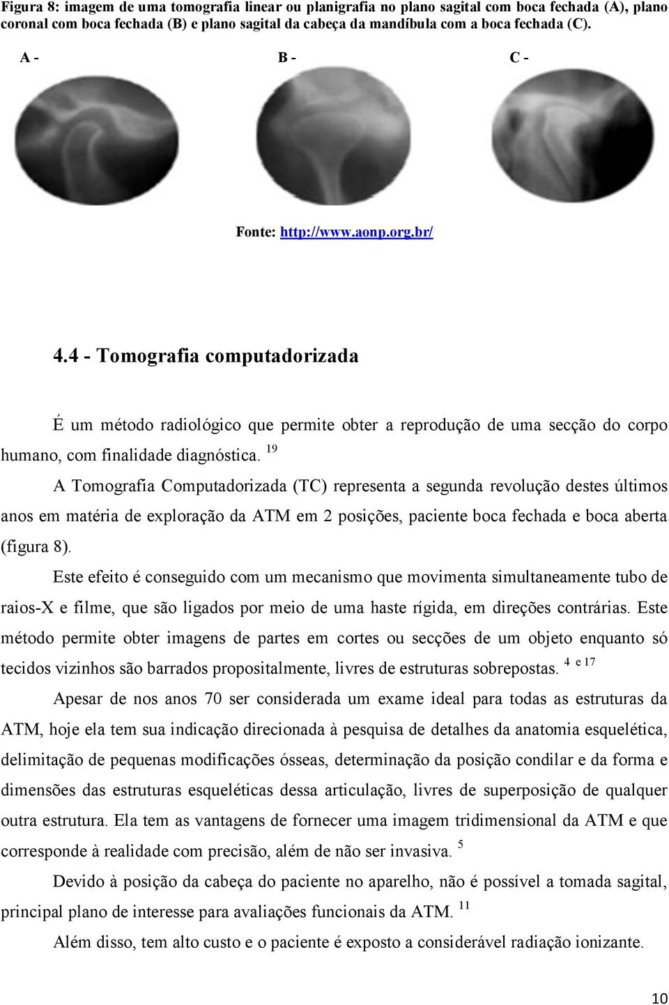 19 A Tomografia Computadorizada (TC) representa a segunda revolução destes últimos anos em matéria de exploração da ATM em 2 posições, paciente boca fechada e boca aberta (figura 8).