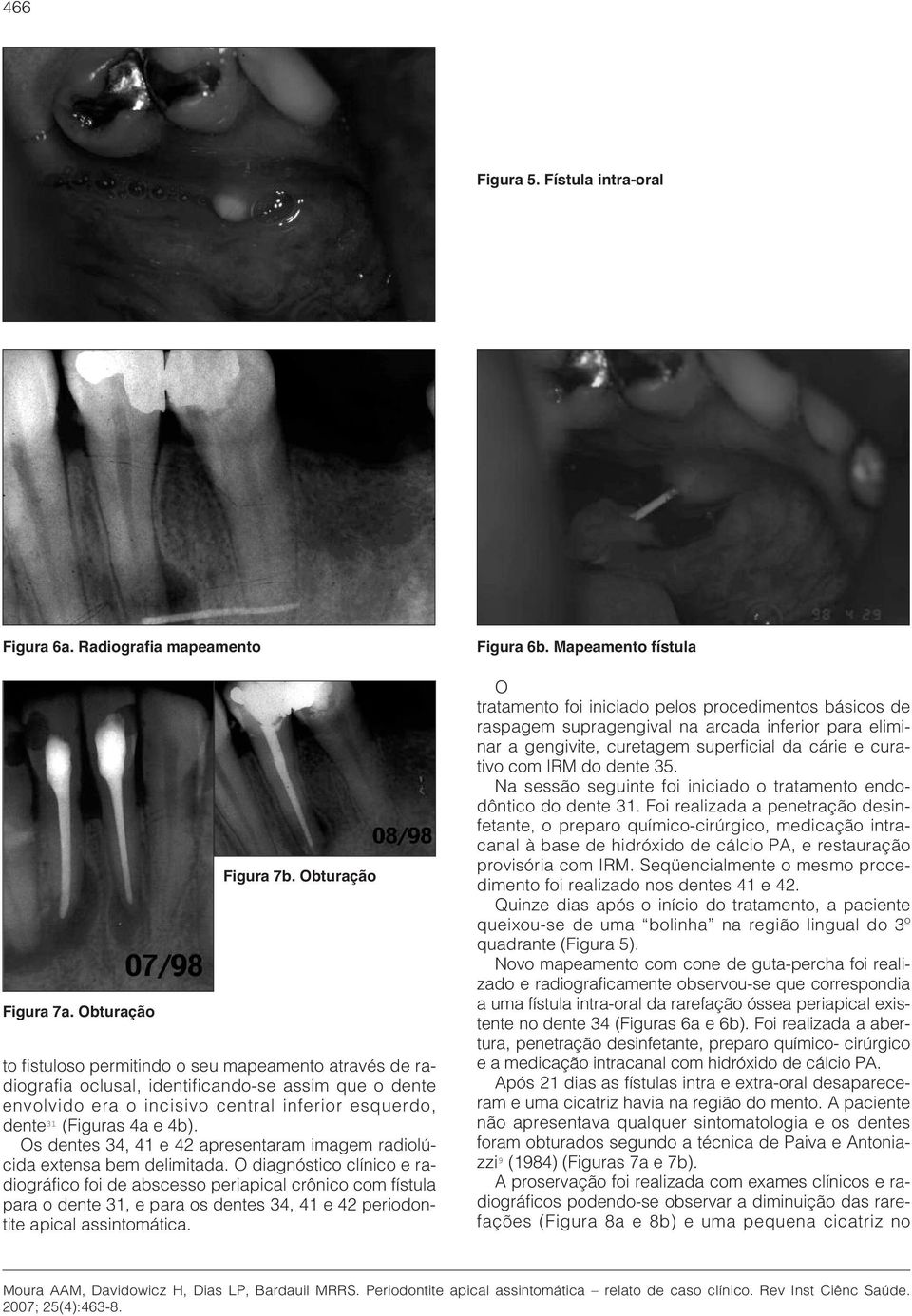Os dentes 34, 41 e 42 apresentaram imagem radiolúcida extensa bem delimitada.