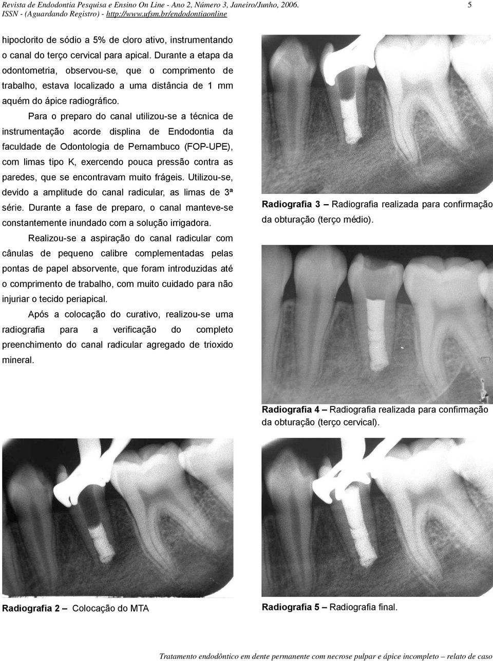 Para o preparo do canal utilizou-se a técnica de instrumentação acorde displina de Endodontia da faculdade de Odontologia de Pernambuco (FOP-UPE), com limas tipo K, exercendo pouca pressão contra as