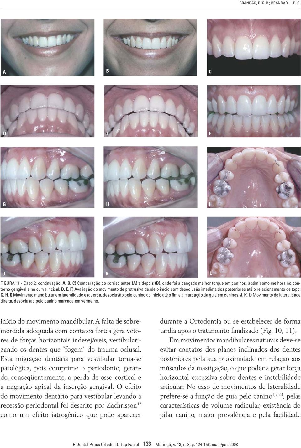 D, E, F) Avaliação do movimento de protrusiva desde o início com desoclusão imediata dos posteriores até o relacionamento de topo.