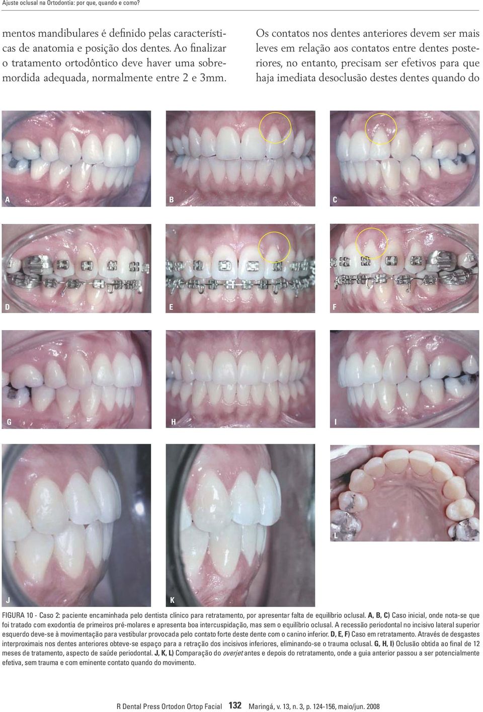 Os contatos nos dentes anteriores devem ser mais leves em relação aos contatos entre dentes posteriores, no entanto, precisam ser efetivos para que haja imediata desoclusão destes dentes quando do A