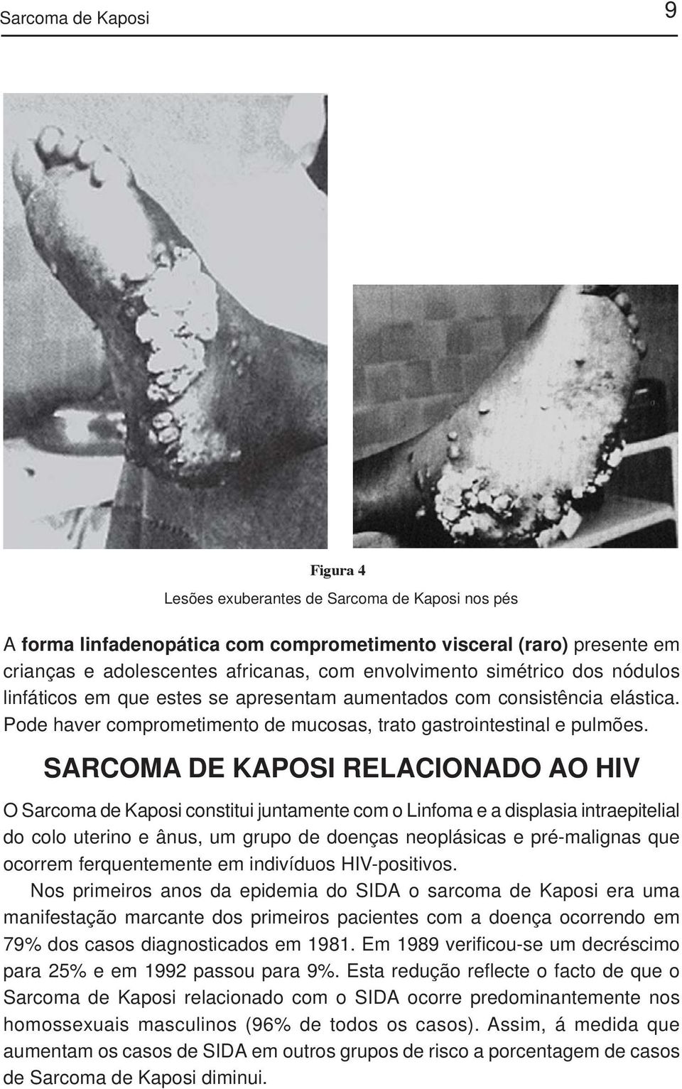 SARCOMA DE KAPOSI RELACIONADO AO HIV O Sarcoma de Kaposi constitui juntamente com o Linfoma e a displasia intraepitelial do colo uterino e ânus, um grupo de doenças neoplásicas e pré-malignas que