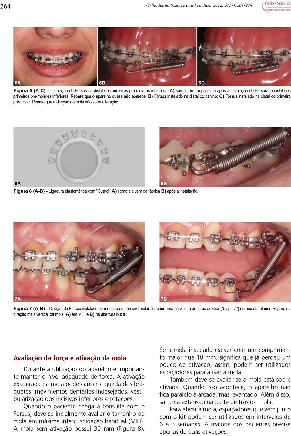 Repare que o aparelho quase não aparece; B) Forsus instalado na distal do canino; C) Forsus instalado na distal do primeiro pré-molar. Repare que a direção da mola não sofre alteração.