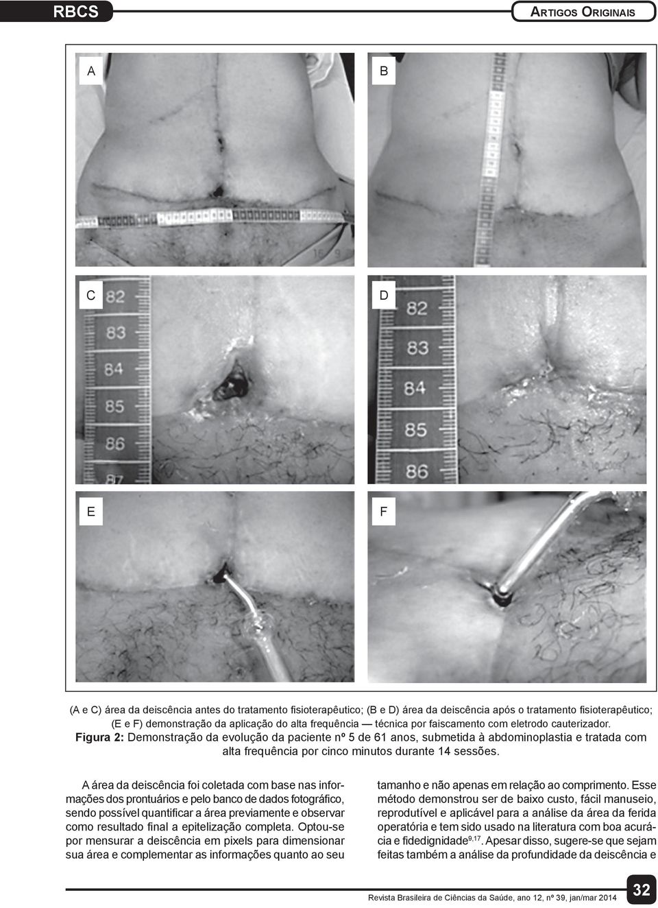 Figura 2: Demonstração da evolução da paciente nº 5 de 61 anos, submetida à abdominoplastia e tratada com alta frequência por cinco minutos durante 14 sessões.