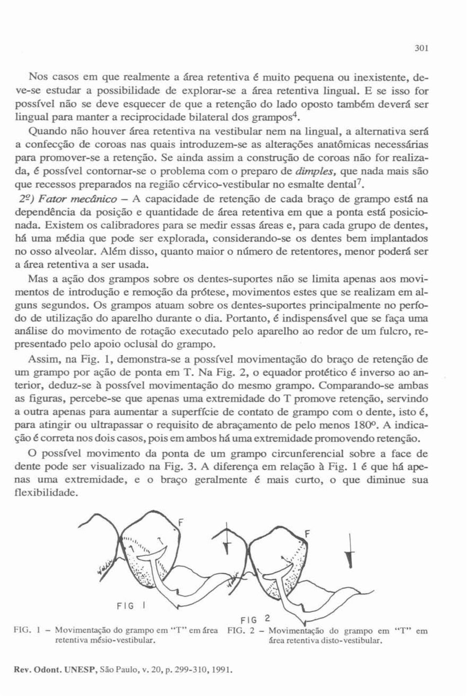 Quando não houver área retenliva na vestibular nem na lingual, a alternativa será a confecção de coroas nas quais introduzem-se as alterações anatómicas necessárias para promover-se a retenção.