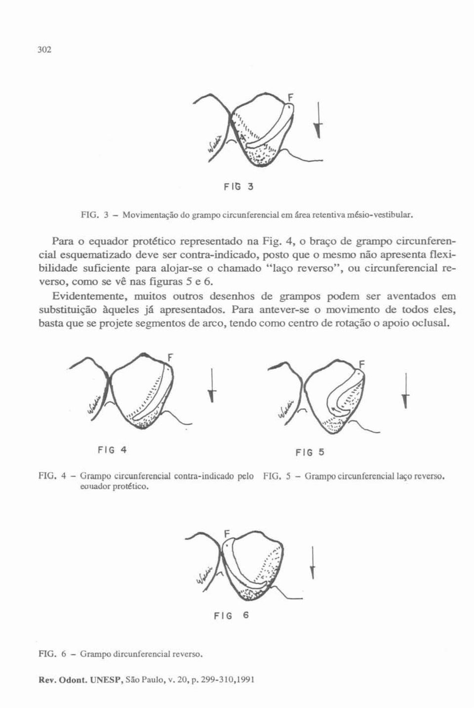 ou circunferencial reverso, como se vê nas figuras 5 e 6. Evidentemente, muitos outros desenhos de grampos podem ser aventados em substituição àqueles jã apresentados.