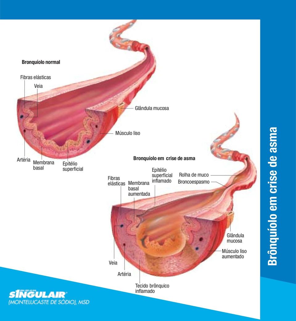 Fibras inflamado elásticas Membrana basal aumentada Veia Rolha de muco Broncoespasmo