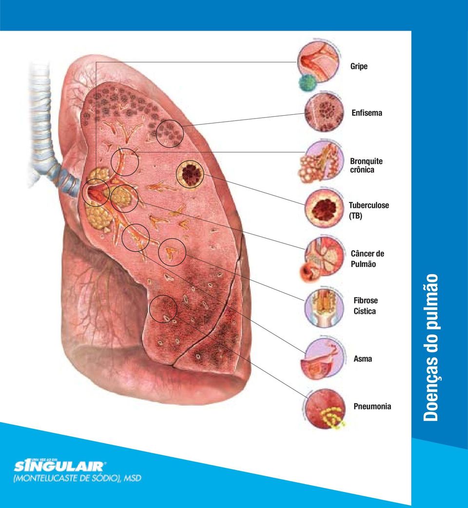 Câncer de Pulmão Fibrose