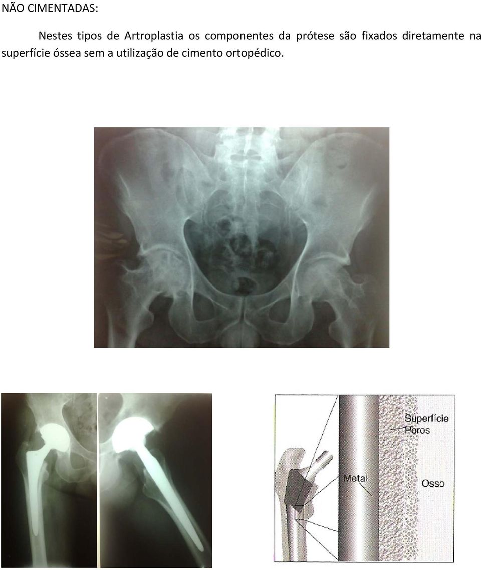 são fixados diretamente na superfície