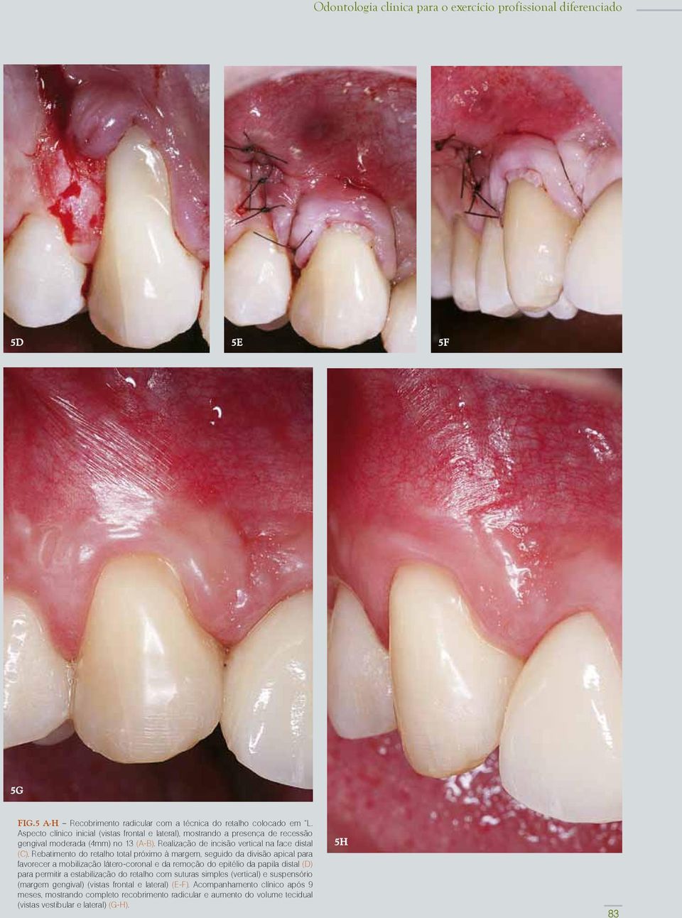 Rebatimento do retalho total próximo à margem, seguido da divisão apical para favorecer a mobilização látero-coronal e da remoção do epitélio da papila distal (D) para permitir a estabilização