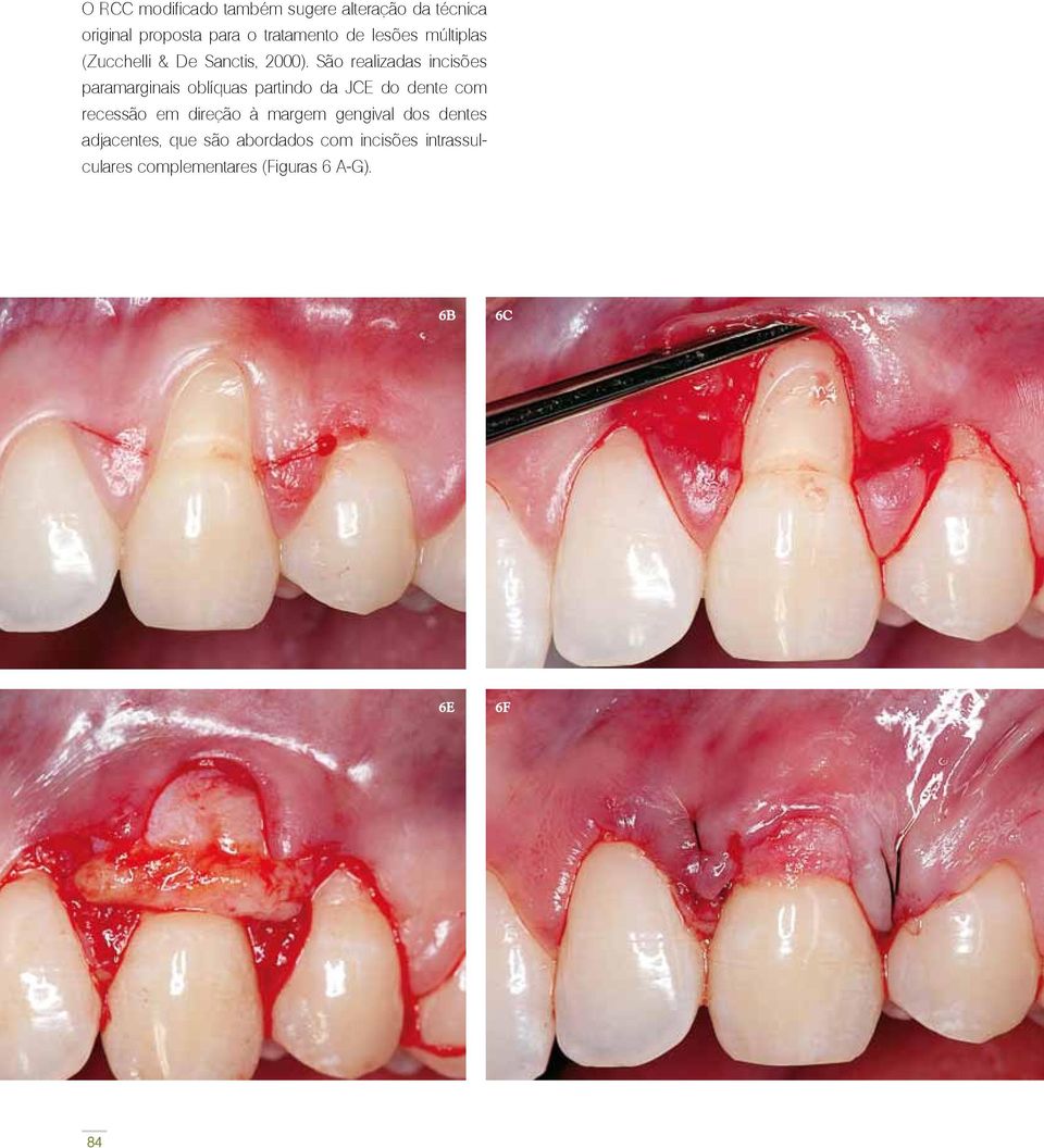 São realizadas incisões paramarginais oblíquas partindo da JCE do dente com recessão em