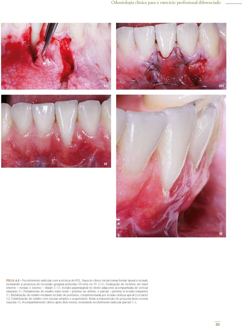 Realização de incisões em bisel (interno mesial, e externo distal) (C-D). Incisão paramarginal no dente adjacente acompanhada de vertical relaxante (E).