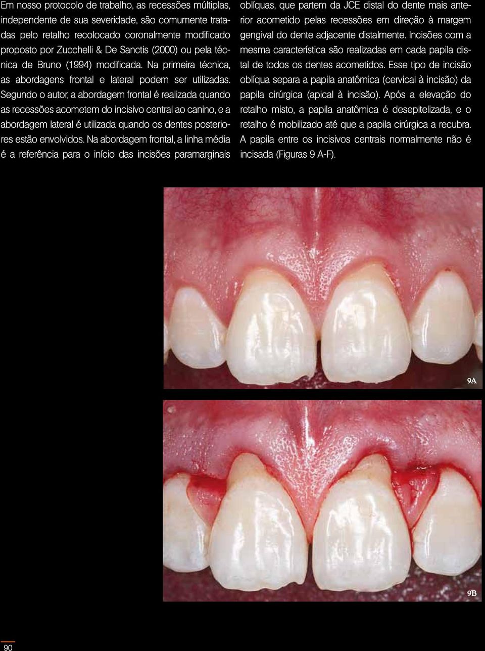 Segundo o autor, a abordagem frontal é realizada quando as recessões acometem do incisivo central ao canino, e a abordagem lateral é utilizada quando os dentes posteriores estão envolvidos.