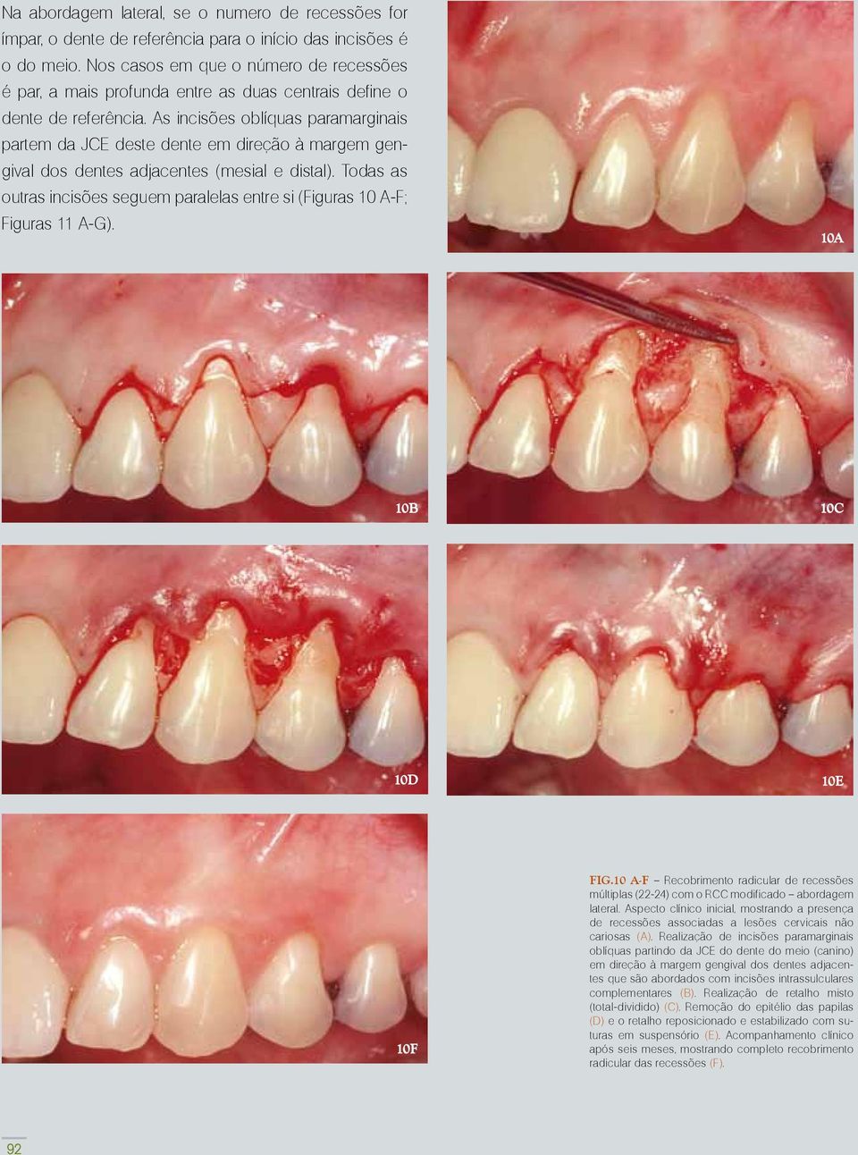 As incisões oblíquas paramarginais partem da JCE deste dente em direção à margem gengival dos dentes adjacentes (mesial e distal).