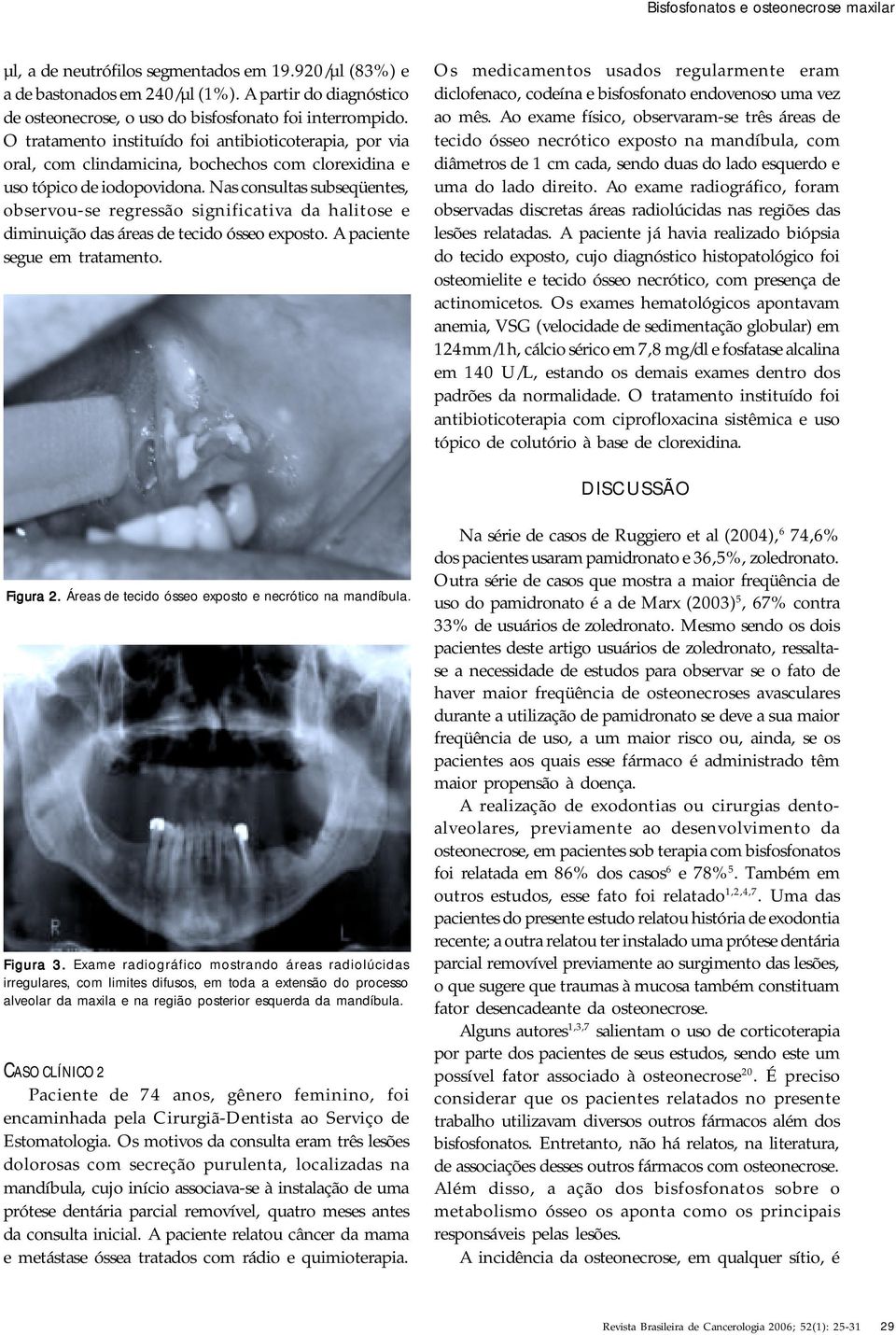 O tratamento instituído foi antibioticoterapia, por via oral, com clindamicina, bochechos com clorexidina e uso tópico de iodopovidona.