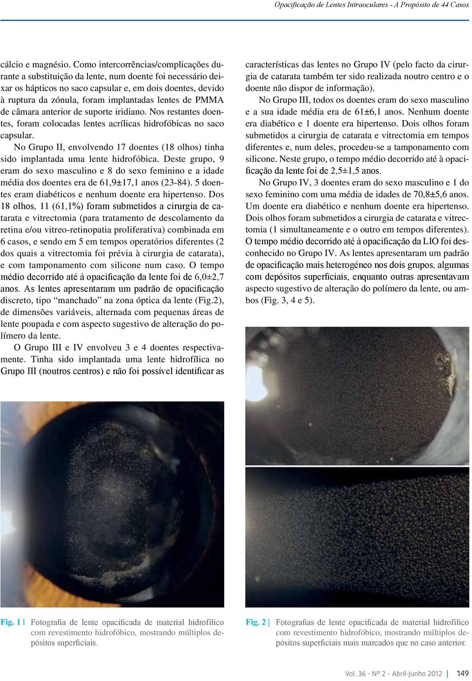 lentes de PMMA de câmara anterior de suporte iridiano. Nos restantes doentes, foram colocadas lentes acrílicas hidrofóbicas no saco capsular.