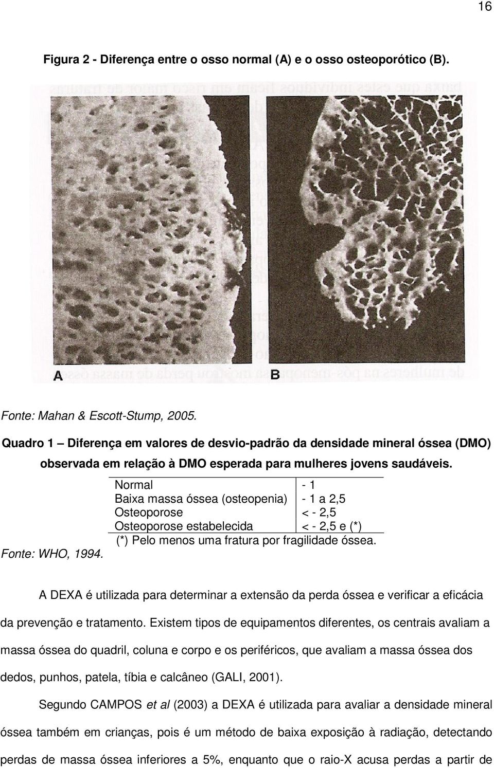 Normal - 1 Baixa massa óssea (osteopenia) - 1 a 2,5 Osteoporose < - 2,5 Osteoporose estabelecida < - 2,5 e (*) (*) Pelo menos uma fratura por fragilidade óssea.