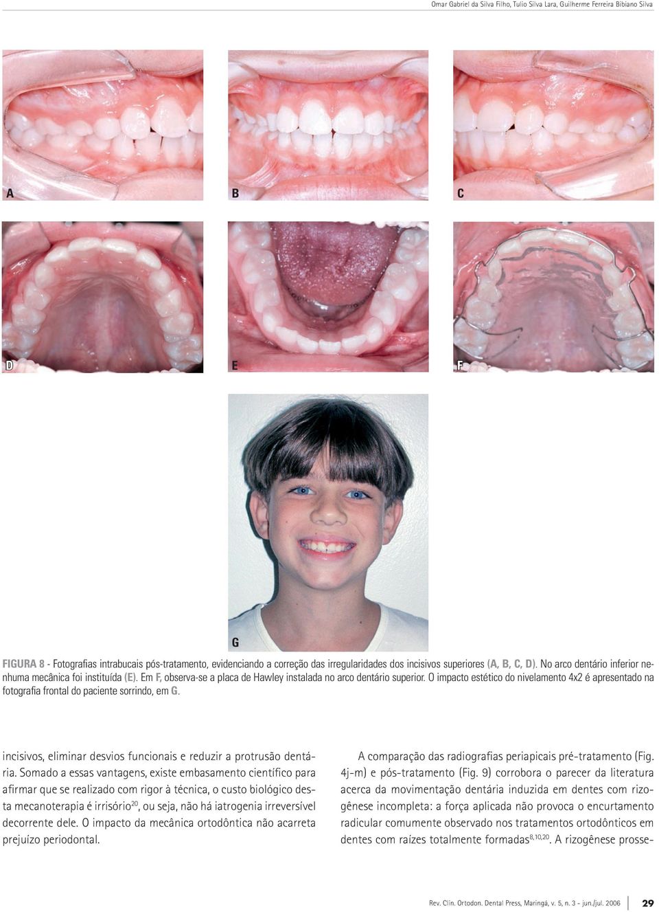 O impacto estético do nivelamento 4x2 é apresentado na fotografia frontal do paciente sorrindo, em G. incisivos, eliminar desvios funcionais e reduzir a protrusão dentária.