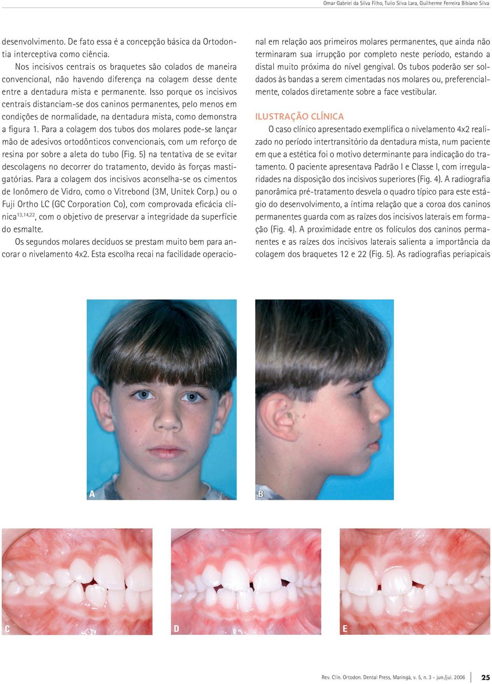 Isso porque os incisivos centrais distanciam-se dos caninos permanentes, pelo menos em condições de normalidade, na dentadura mista, como demonstra a figura 1.