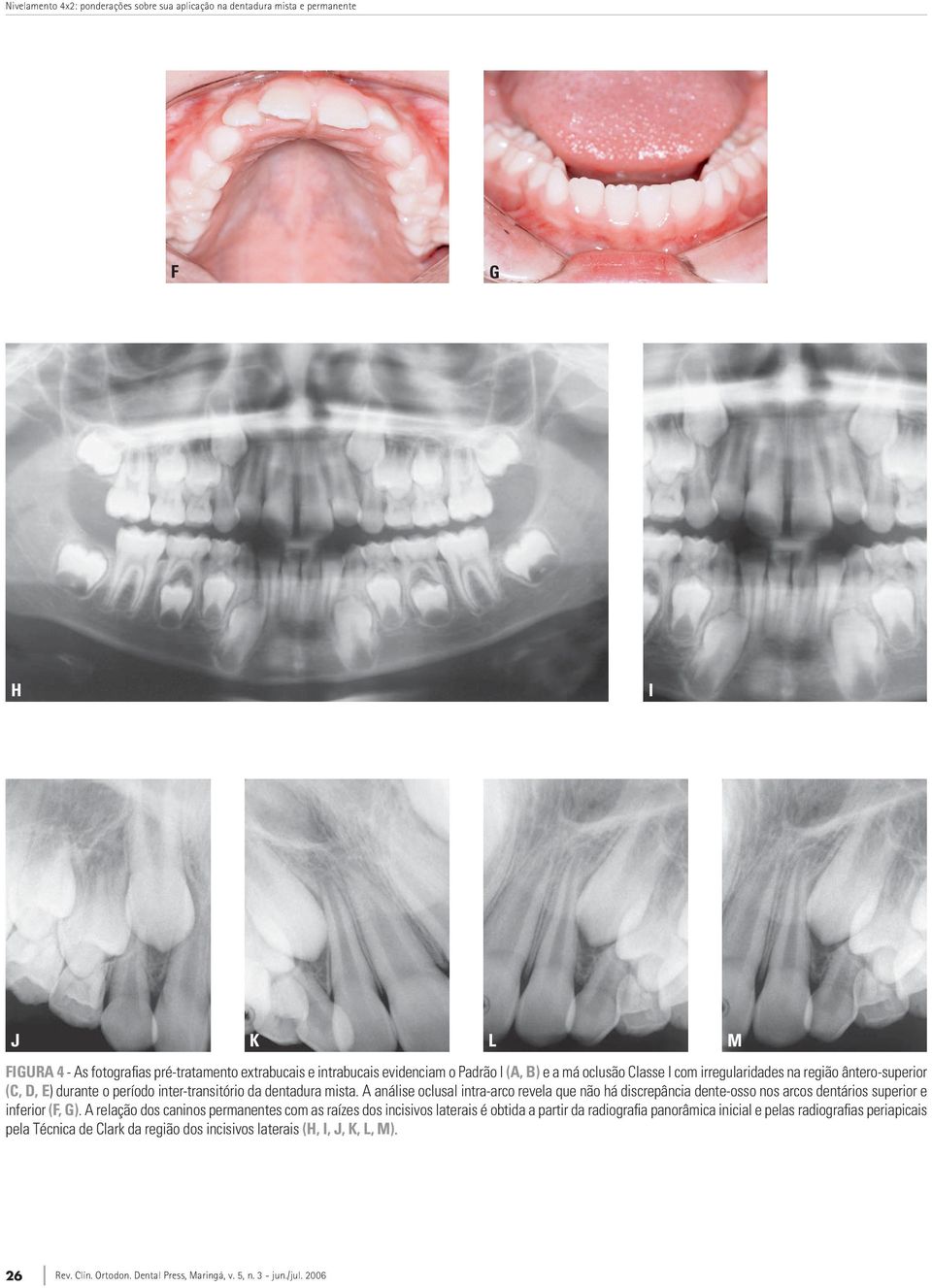 A análise oclusal intra-arco revela que não há discrepância dente-osso nos arcos dentários superior e inferior (F, G).