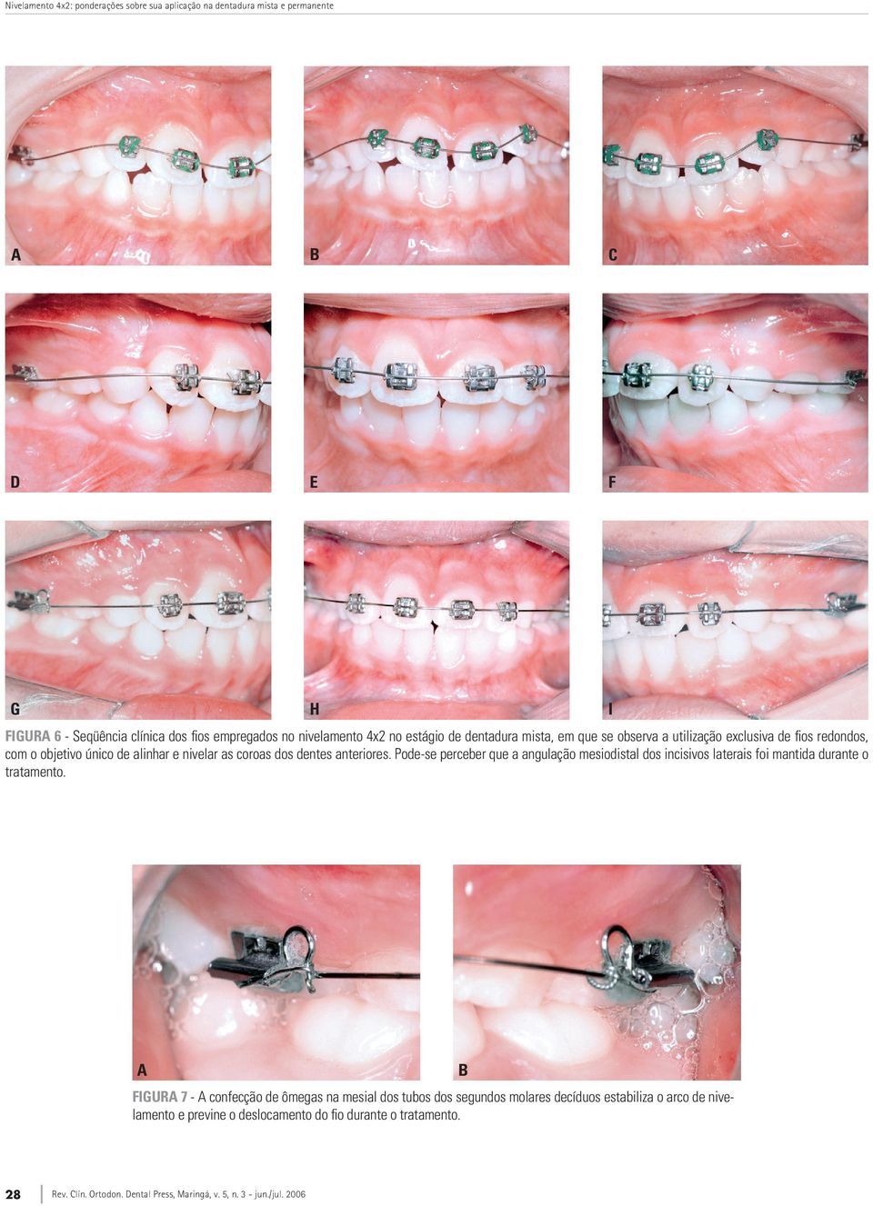 coroas dos dentes anteriores. Pode-se perceber que a angulação mesiodistal dos incisivos laterais foi mantida durante o tratamento.