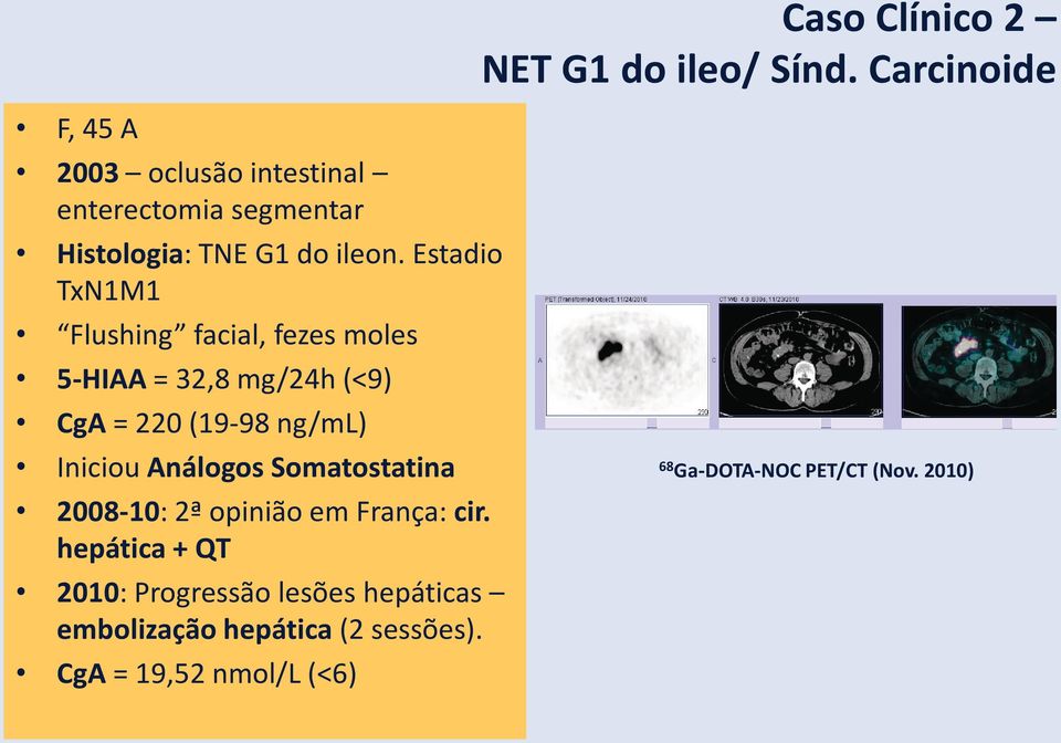 Estadio TxN1M1 Flushing facial, fezes moles 5-HIAA = 32,8 mg/24h (<9) CgA = 220 (19-98 ng/ml) Iniciou