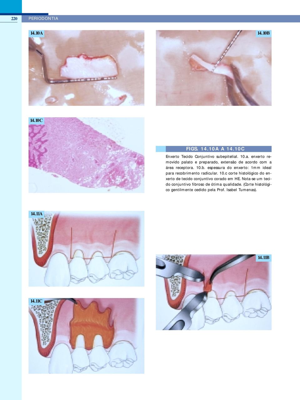 espessura do enxerto: 1mm ideal para recobrimento radicular. 10.