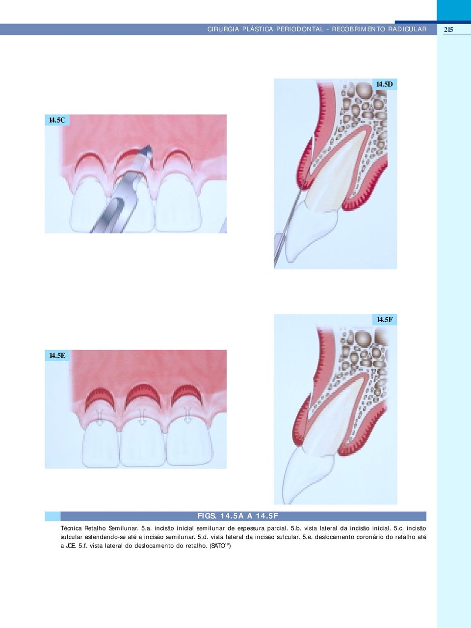 vista lateral da incisão inicial. 5.c. incisão sulcular estendendo-se até a incisão semilunar. 5.d. vista lateral da incisão sulcular.