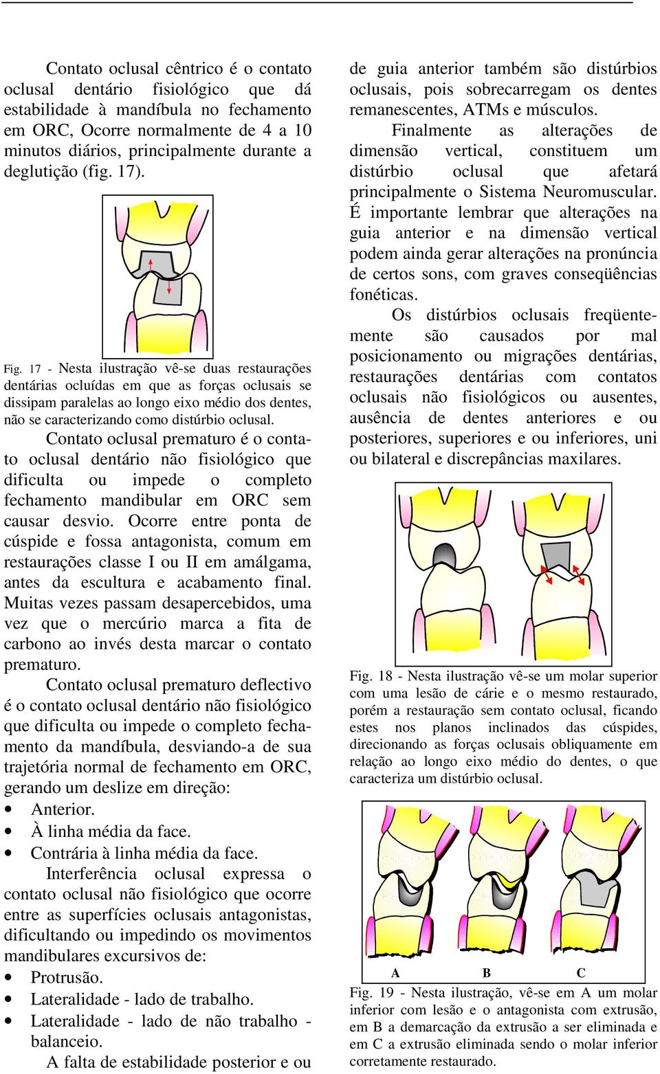 17 - Nesta ilustração vê-se duas restaurações dentárias ocluídas em que as forças oclusais se dissipam paralelas ao longo eixo médio dos dentes, não se caracterizando como distúrbio oclusal.