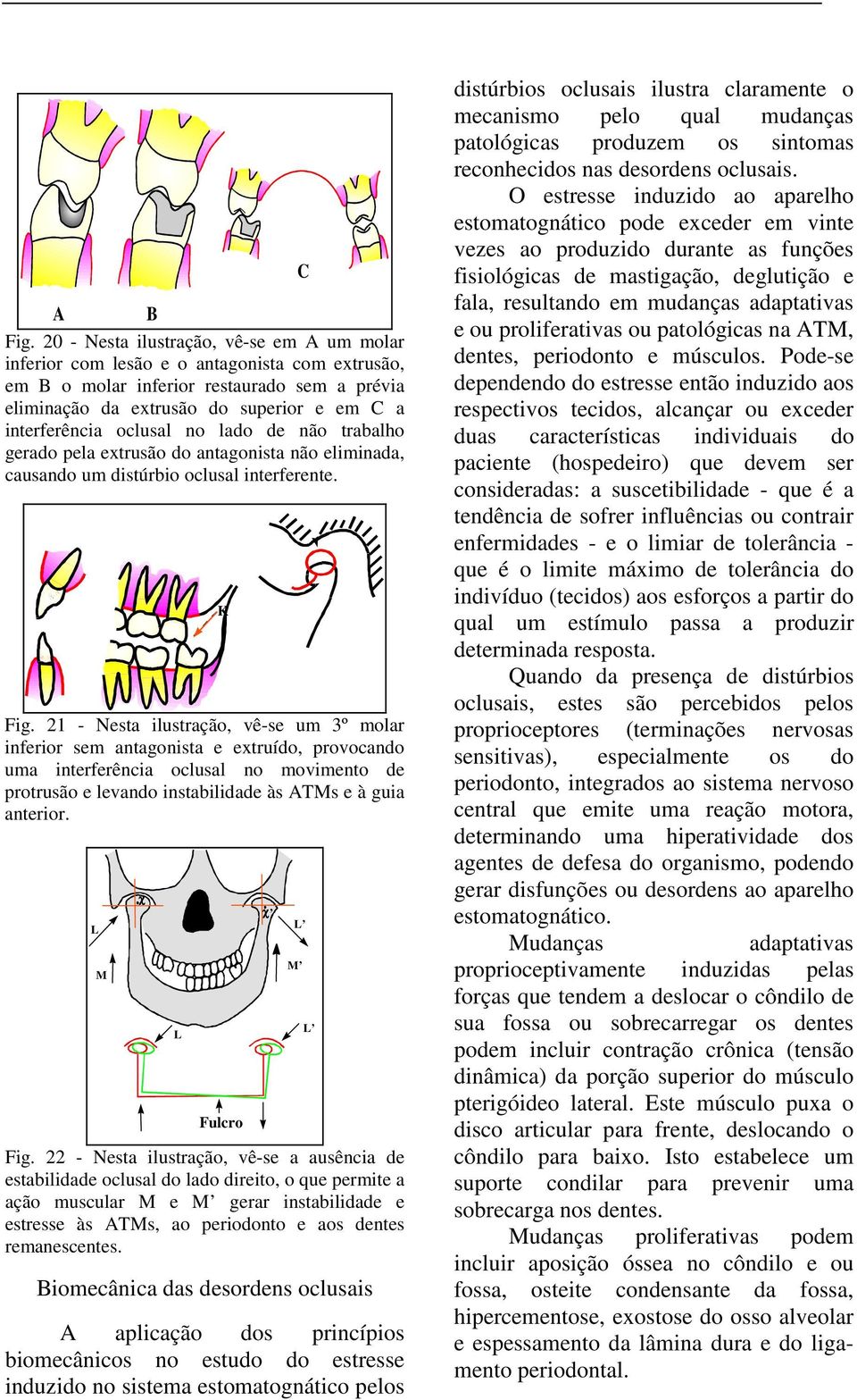 oclusal no lado de não trabalho gerado pela extrusão do antagonista não eliminada, causando um distúrbio oclusal interferente. Fig.