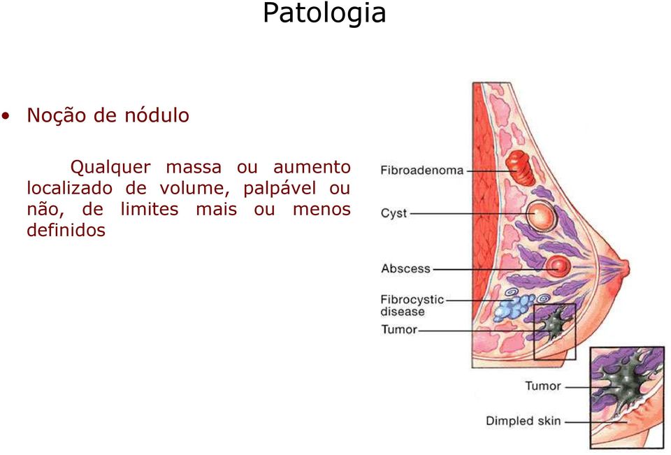 localizado de volume, palpável