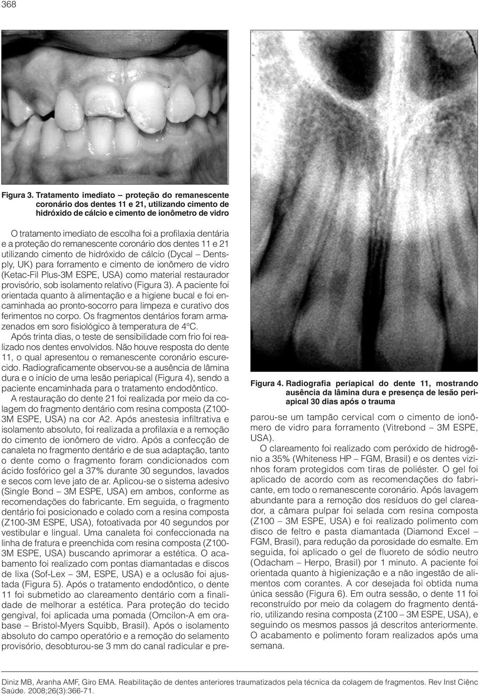 dentária e a proteção do remanescente coronário dos dentes 11 e 21 utilizando cimento de hidróxido de cálcio (Dycal Dentsply, UK) para forramento e cimento de ionômero de vidro (Ketac-Fil Plus-3M