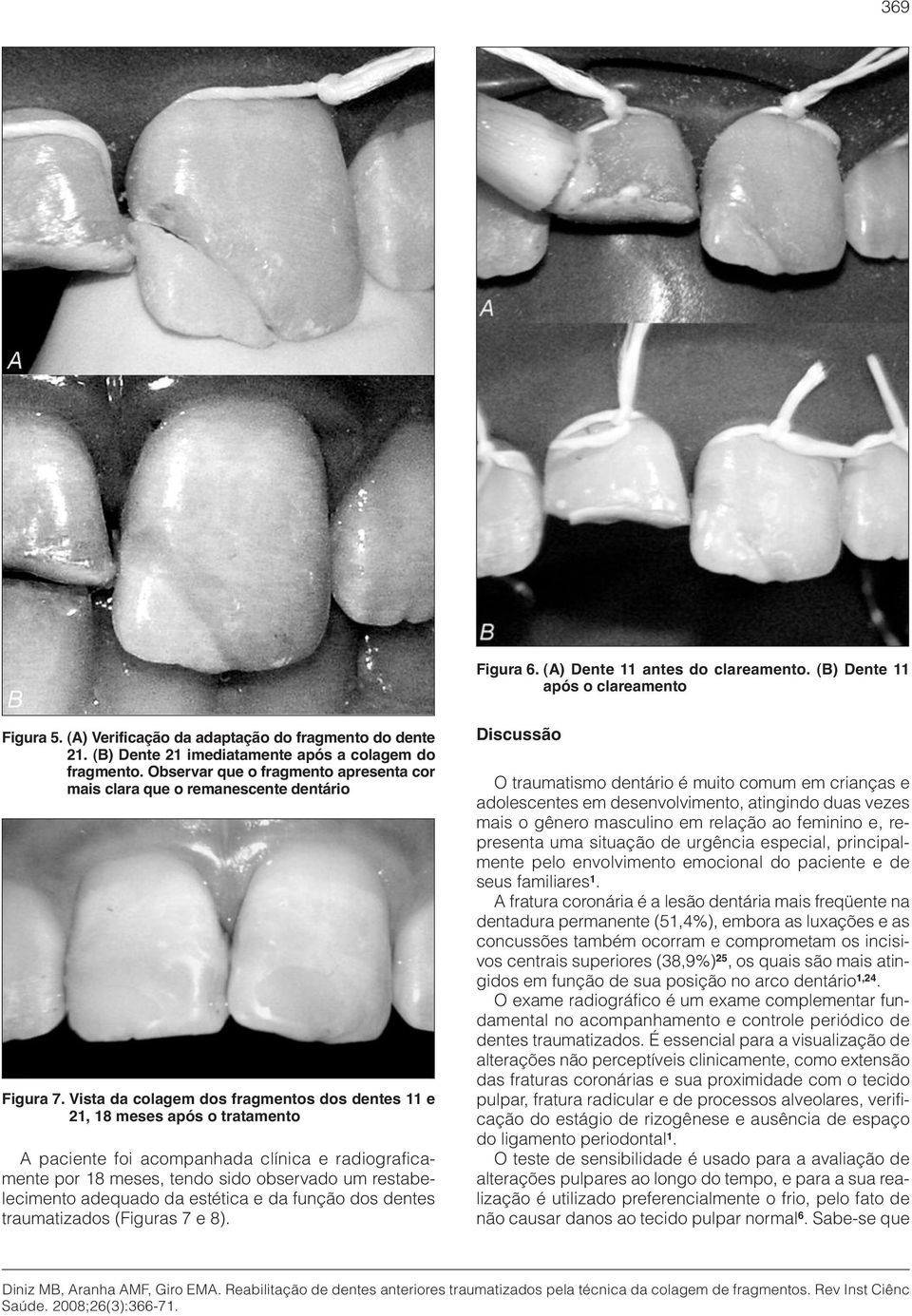 Vista da colagem dos fragmentos dos dentes 11 e 21, 18 meses após o tratamento A paciente foi acompanhada clínica e radiograficamente por 18 meses, tendo sido observado um restabelecimento adequado