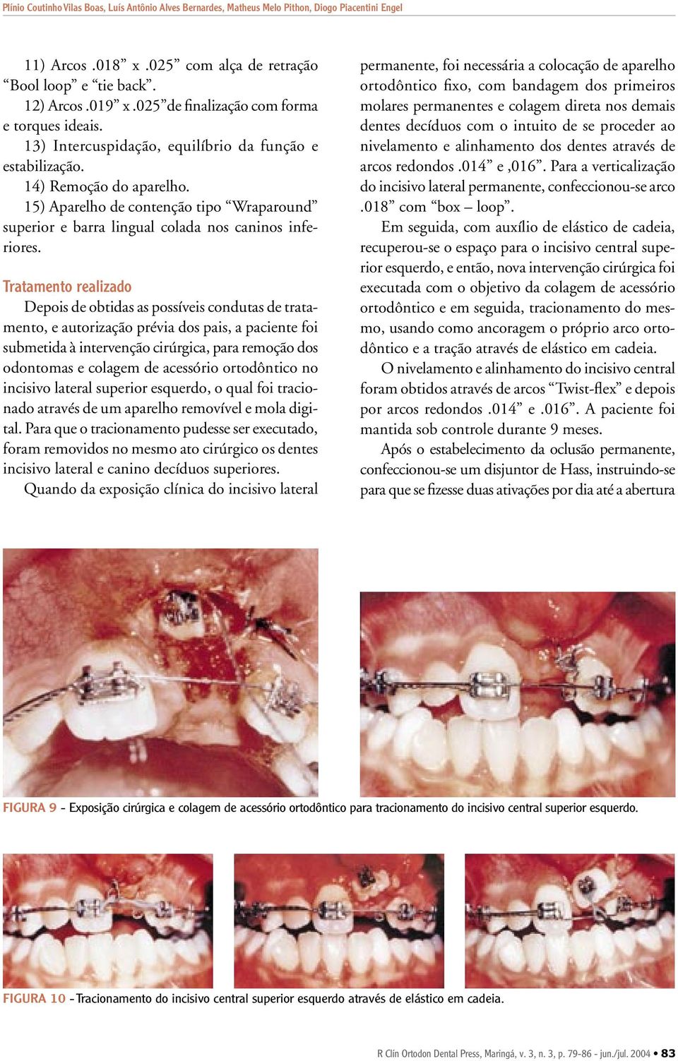 15) Aparelho de contenção tipo Wraparound superior e barra lingual colada nos caninos inferiores.