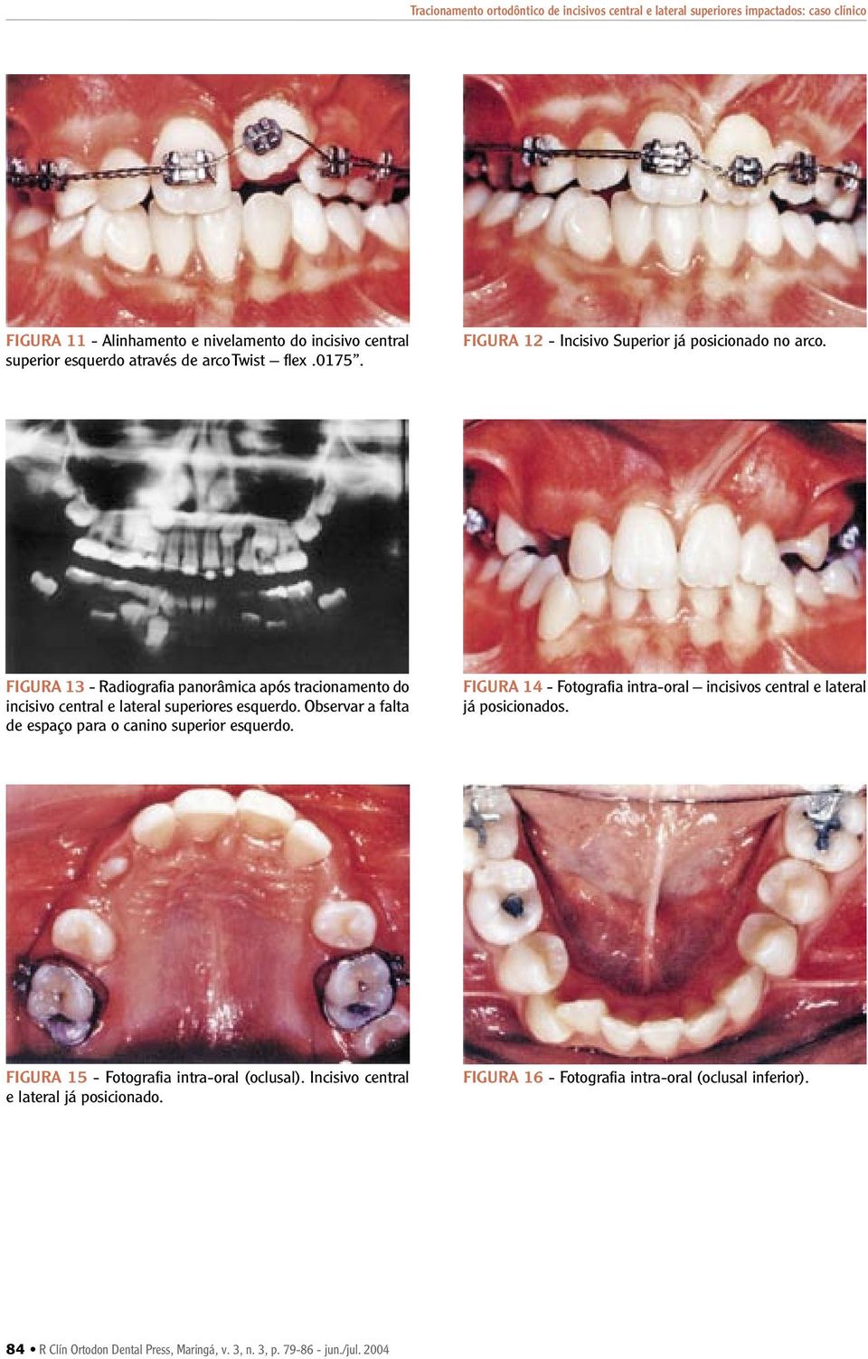 Observar a falta de espaço para o canino superior esquerdo. FIGURA 14 - Fotografia intra-oral incisivos central e lateral já posicionados.