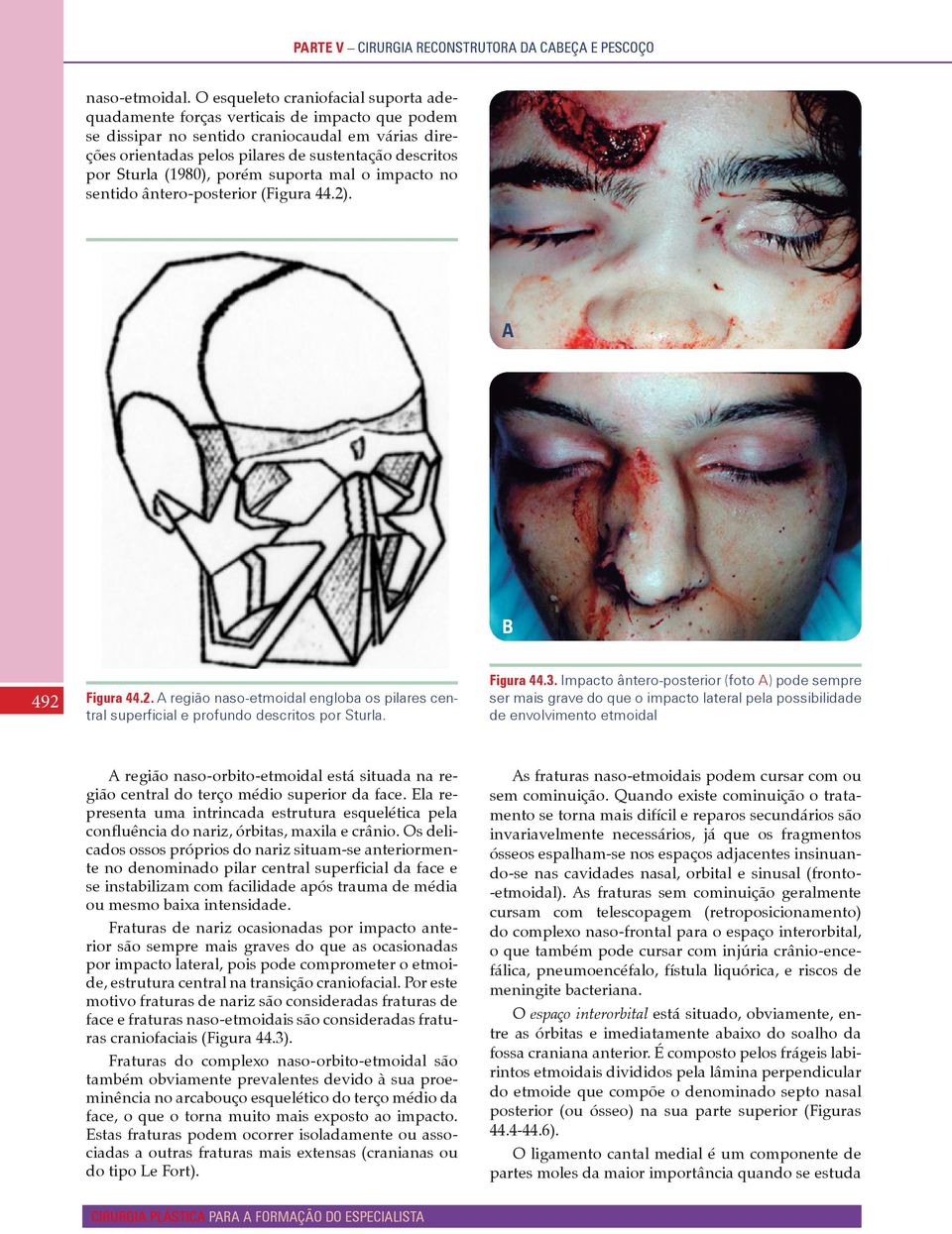 Sturla (1980), porém suporta mal o impacto no sentido ântero-posterior (Figura 44.2). A B 492 Figura 44.2. A região naso-etmoidal engloba os pilares central superficial e profundo descritos por Sturla.