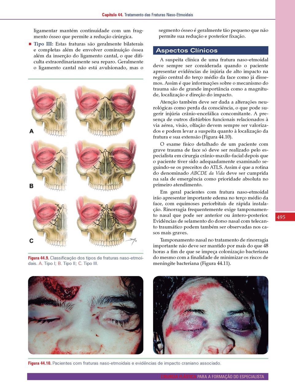 Geralmente o ligamento cantal não está avulsionado, mas o Figura 44.9. Classificação dos tipos de fraturas naso-etmoidais. A. Tipo I; B. Tipo II; C. Tipo III.