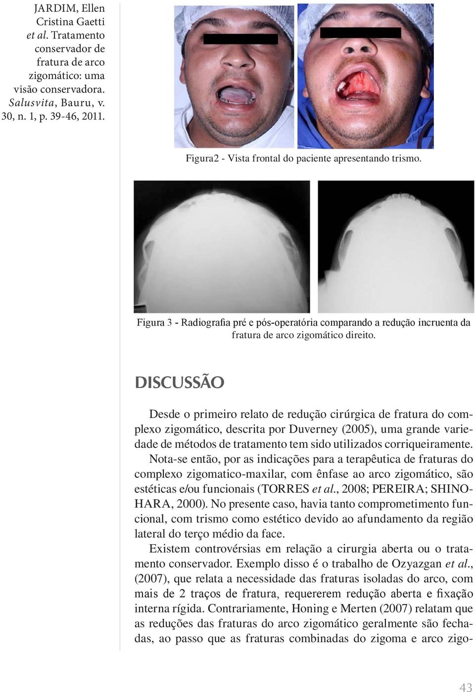 corriqueiramente. Nota-se então, por as indicações para a terapêutica de fraturas do complexo zigomatico-maxilar, com ênfase ao arco zigomático, são estéticas e/ou funcionais (TORRES et al.