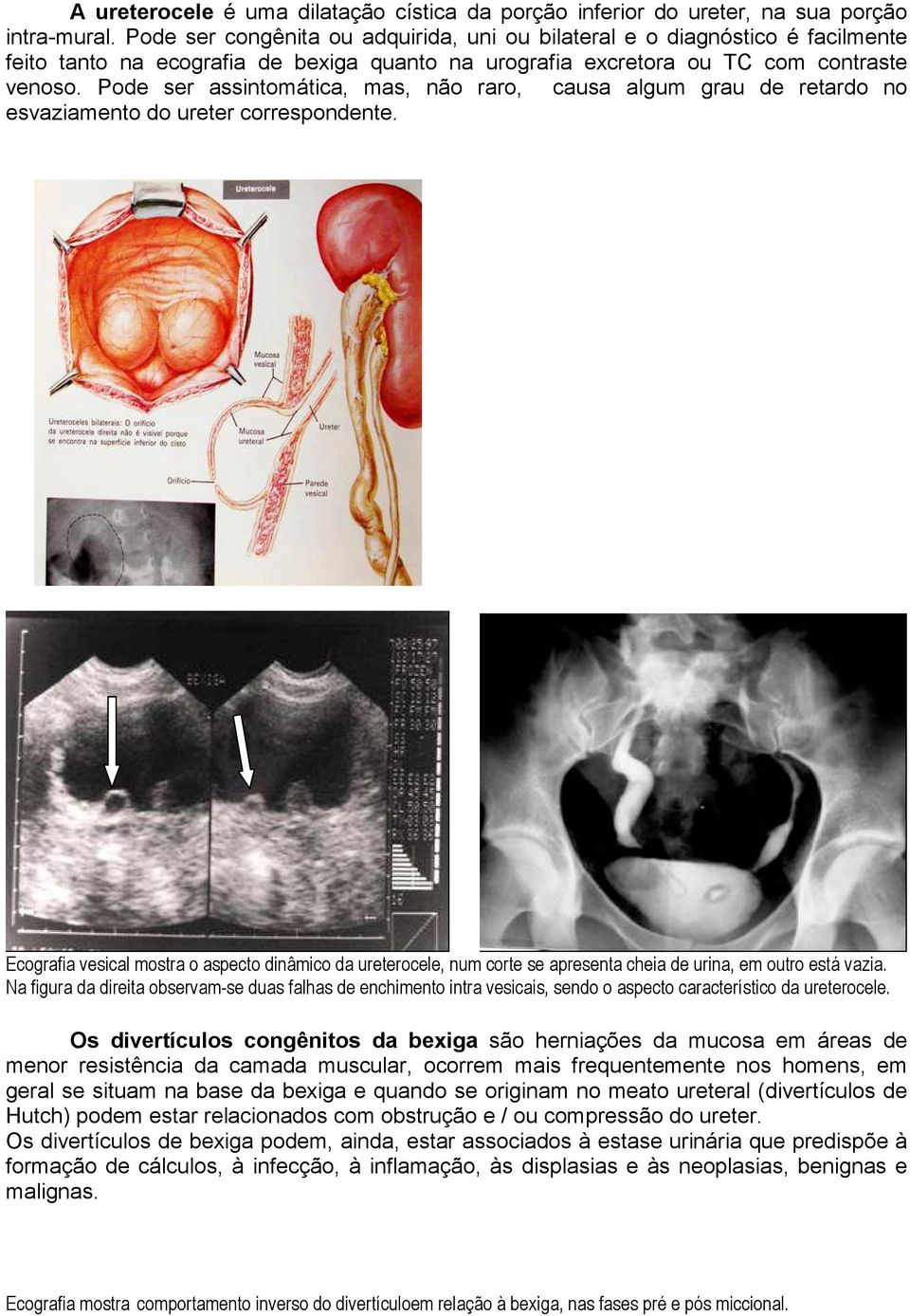 Pode ser assintomática, mas, não raro, causa algum grau de retardo no esvaziamento do ureter correspondente.