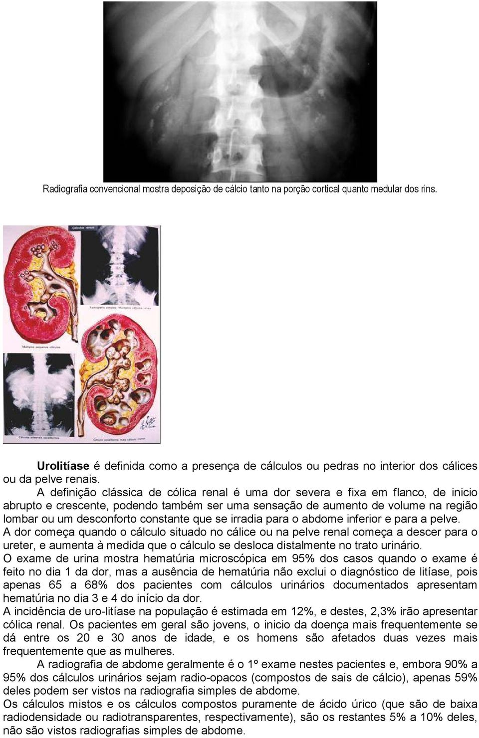 A definição clássica de cólica renal é uma dor severa e fixa em flanco, de inicio abrupto e crescente, podendo também ser uma sensação de aumento de volume na região lombar ou um desconforto