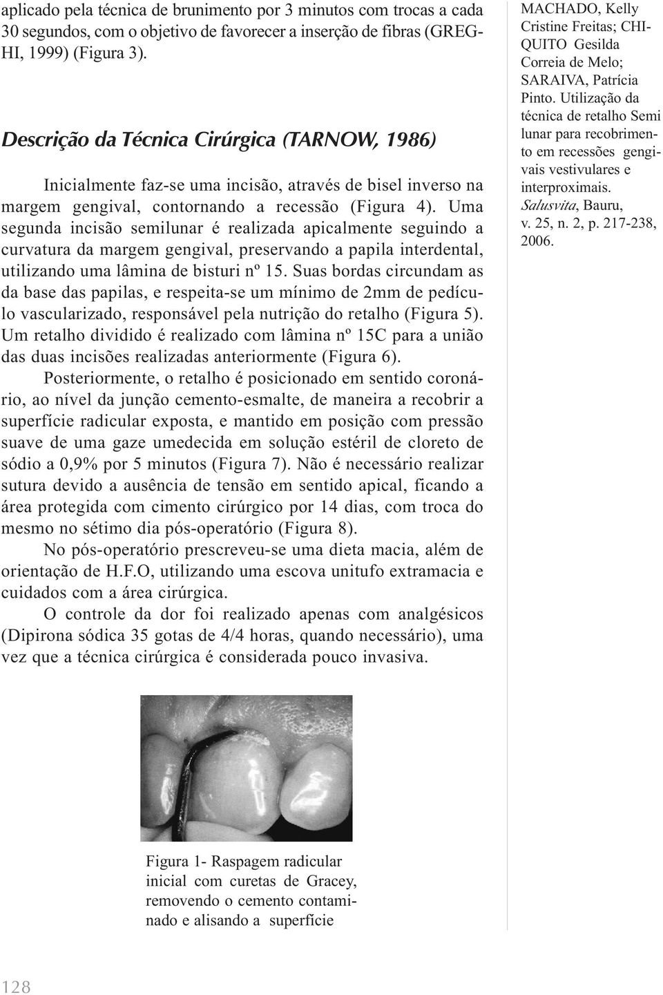 Uma segunda incisão semilunar é realizada apicalmente seguindo a curvatura da margem gengival, preservando a papila interdental, utilizando uma lâmina de bisturi nº 15.