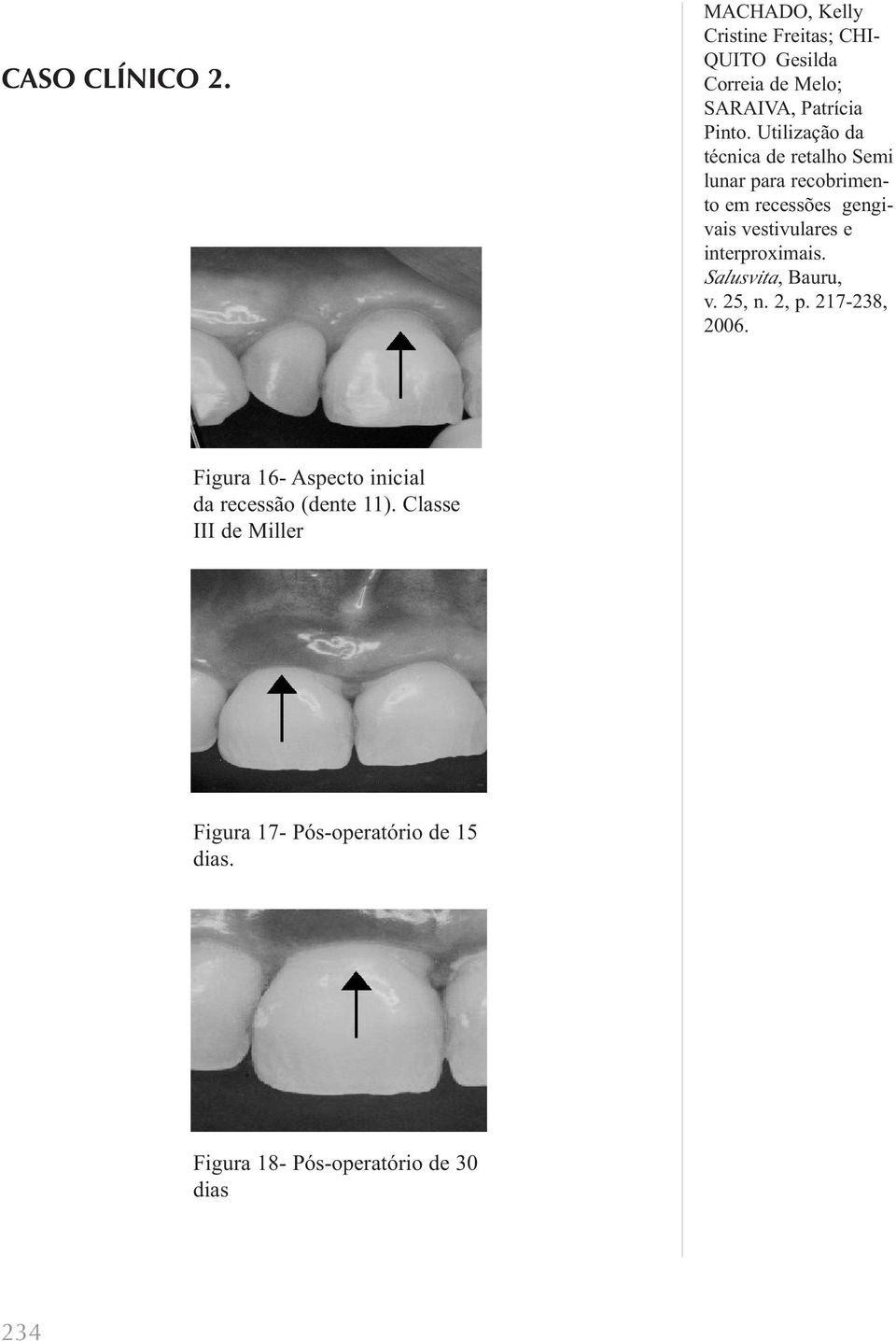 recessão (dente 11).