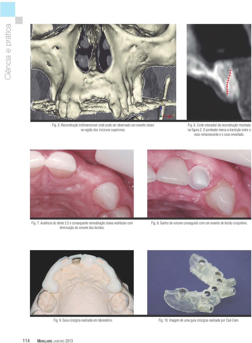 Ausência do dente 2.2 e consequente remodelação óssea vestibular com diminuição do volume dos tecidos. Fig. 8.