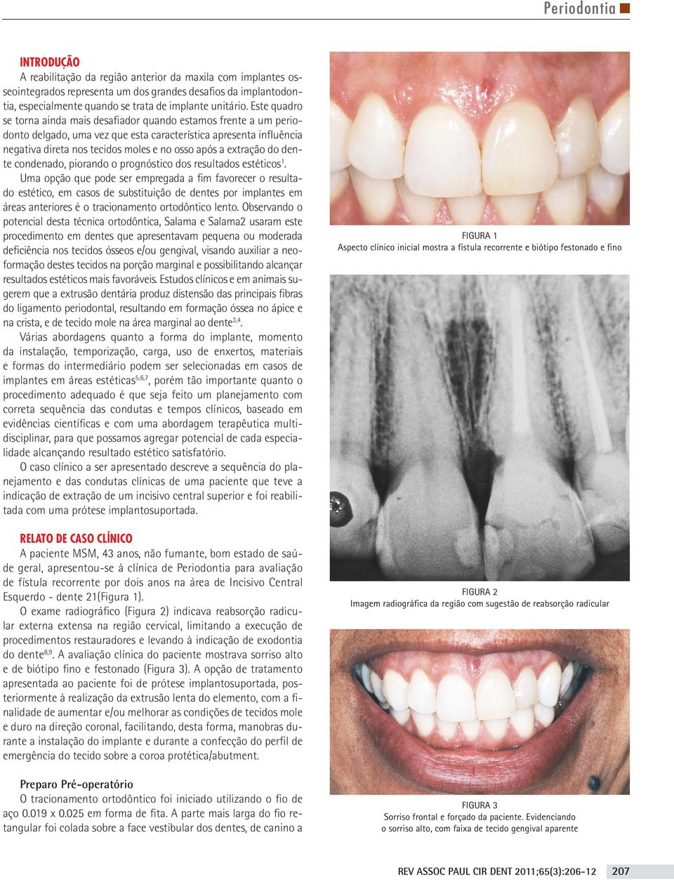 Este quadro se torna ainda mais desafiador quando estamos frente a um periodonto delgado, uma vez que esta característica apresenta influência negativa direta nos tecidos moles e no osso após a