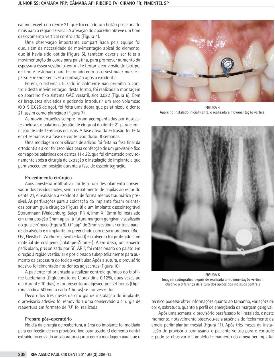 Uma observação importante compartilhada pela equipe foi que, além da necessidade de movimentação apical do elemento, que já havia sido obtida (Figura 5), também deveria ser feita a movimentação da