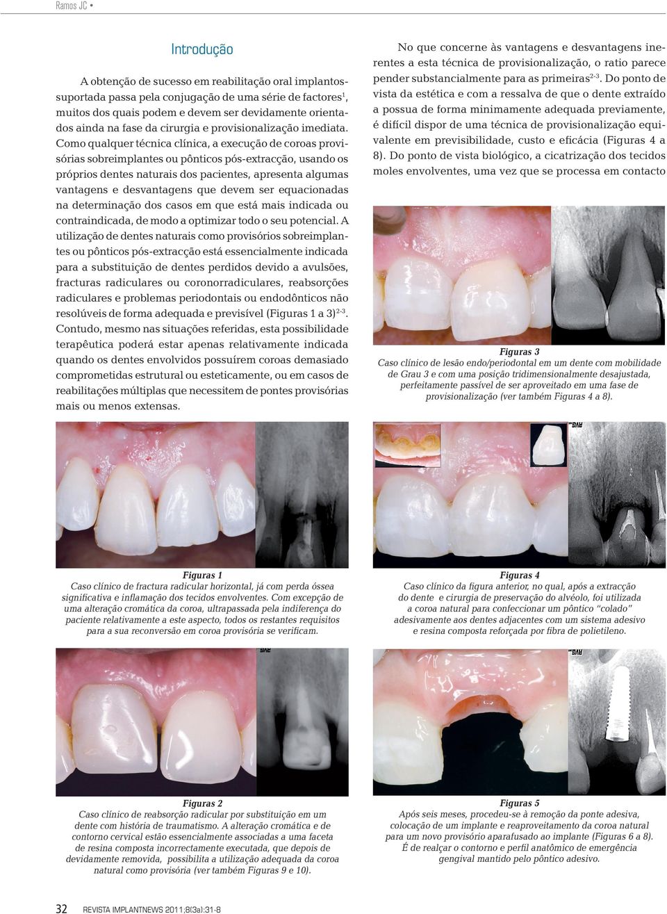 Como qualquer técnica clínica, a execução de coroas provisórias sobreimplantes ou pônticos pós-extracção, usando os próprios dentes naturais dos pacientes, apresenta algumas vantagens e desvantagens